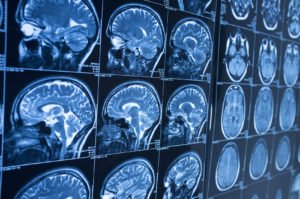 How Marzzacco Niven & Associates Can Help With a Brain Injury Claim in Carbondale